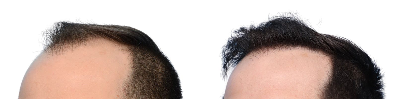 FUE Hair Transplant Before & After Gallery - Patient 427638 - Image 3