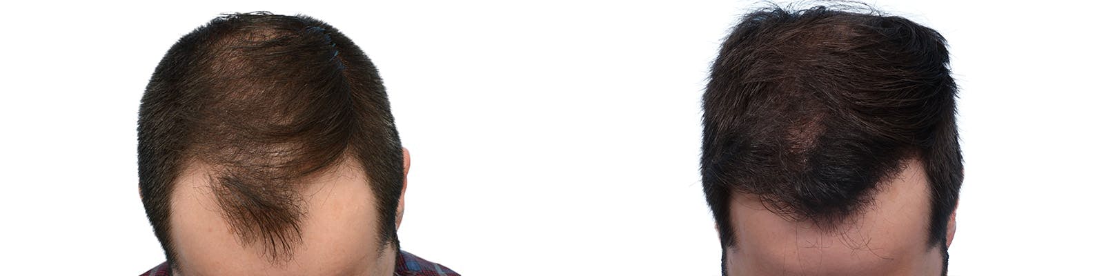 FUE Hair Transplant Before & After Gallery - Patient 427638 - Image 4