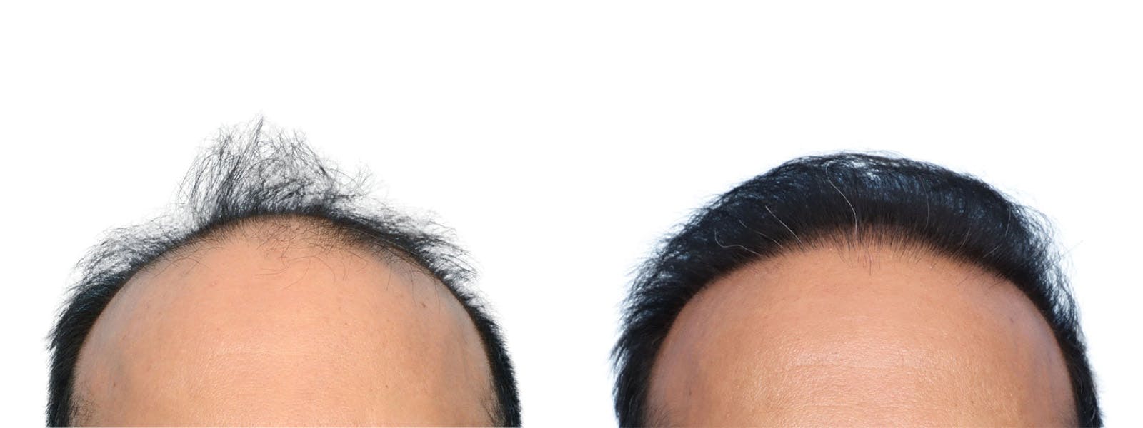 FUE Hair Transplant Before & After Gallery - Patient 268762 - Image 1