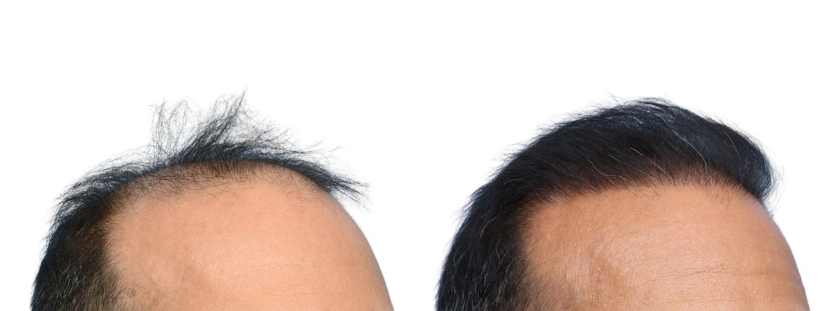 FUE Hair Transplant Before & After Gallery - Patient 268762 - Image 2