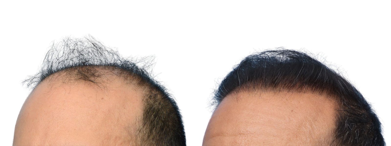 FUE Hair Transplant Before & After Gallery - Patient 268762 - Image 3