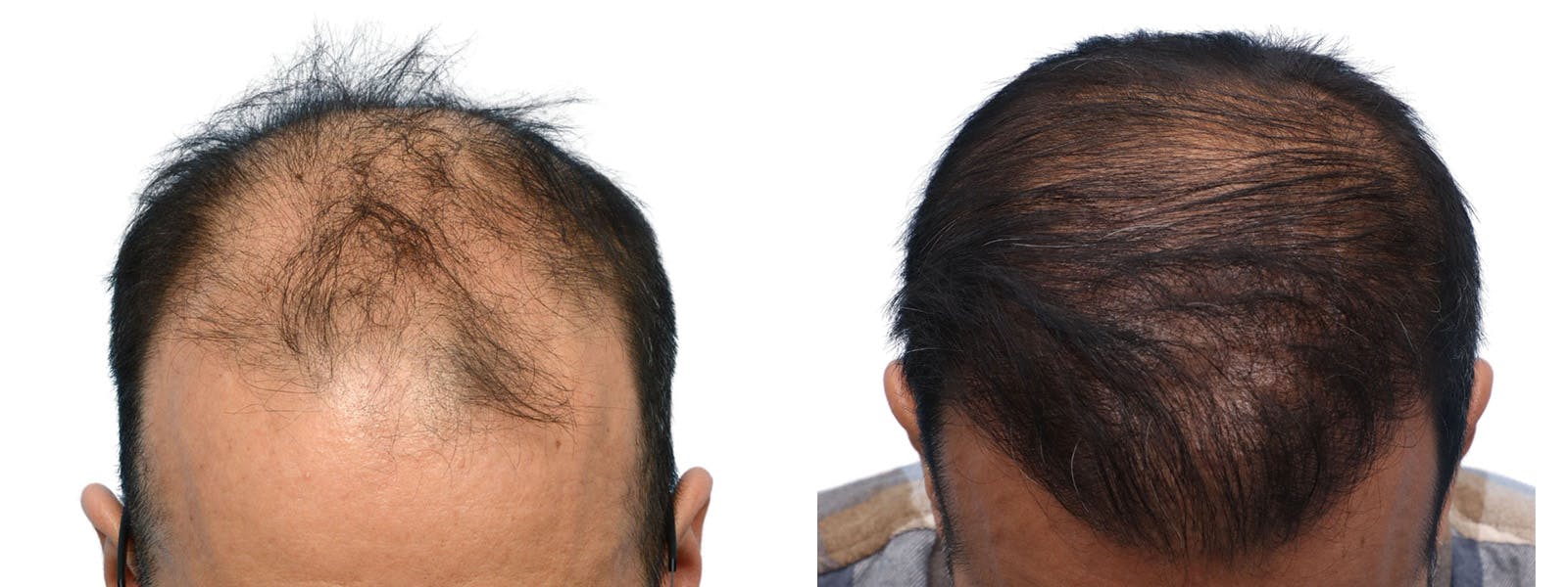 FUE Hair Transplant Before & After Gallery - Patient 268762 - Image 4