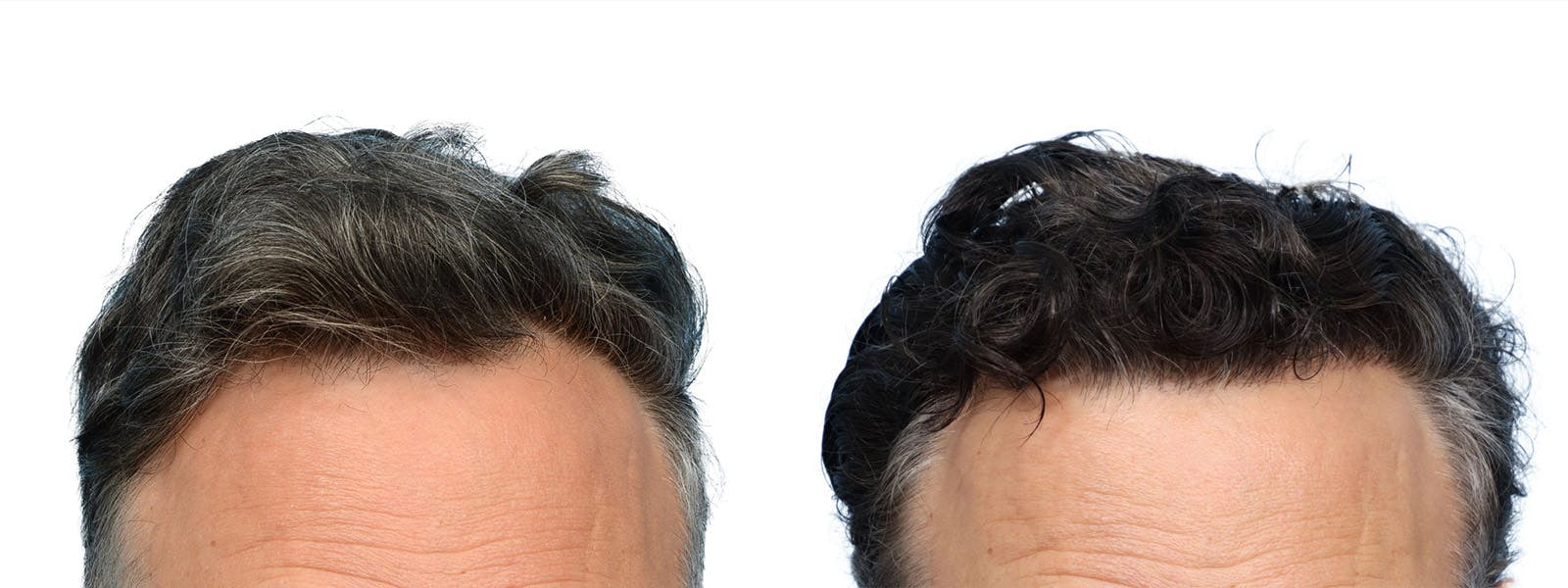 FUE Hair Transplant Before & After Gallery - Patient 253252 - Image 1