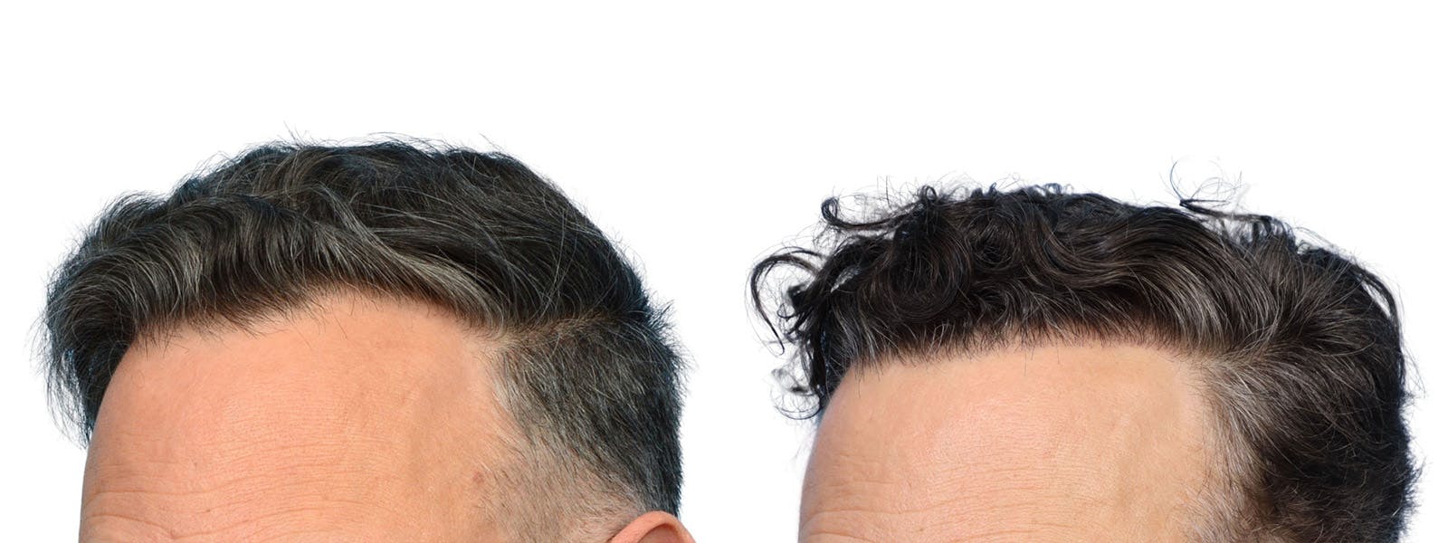 FUE Hair Transplant Before & After Gallery - Patient 253252 - Image 2