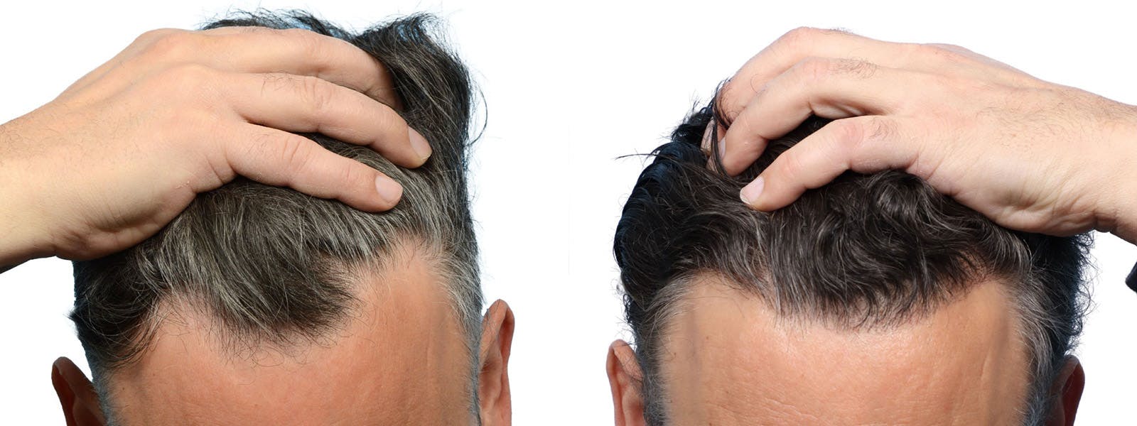FUE Hair Transplant Before & After Gallery - Patient 253252 - Image 3