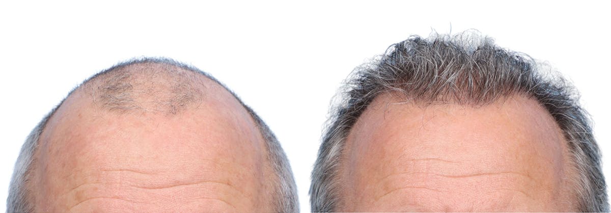 FUE Hair Transplant Before & After Gallery - Patient 242809 - Image 1