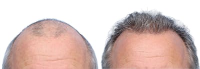 FUE Hair Transplant Before & After Gallery - Patient 242809 - Image 1