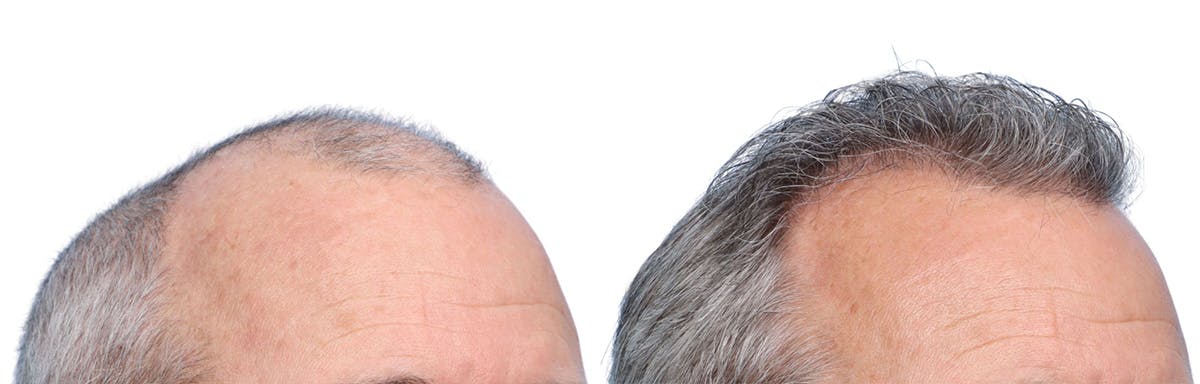 FUE Hair Transplant Before & After Gallery - Patient 242809 - Image 2
