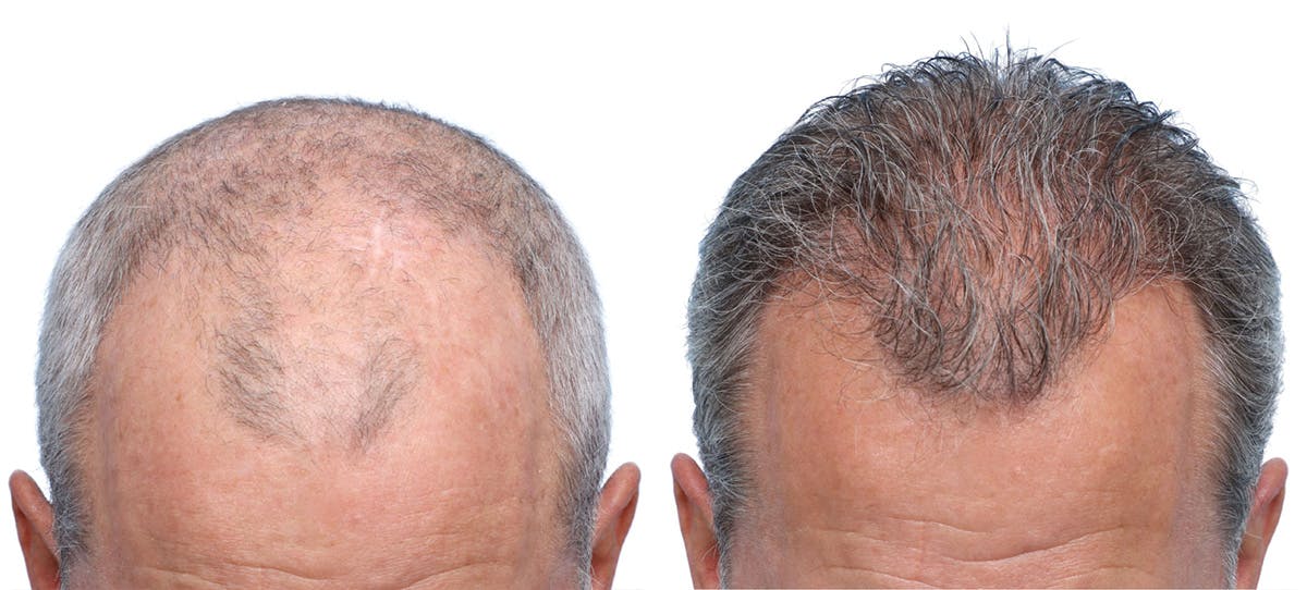 FUE Hair Transplant Before & After Gallery - Patient 242809 - Image 4