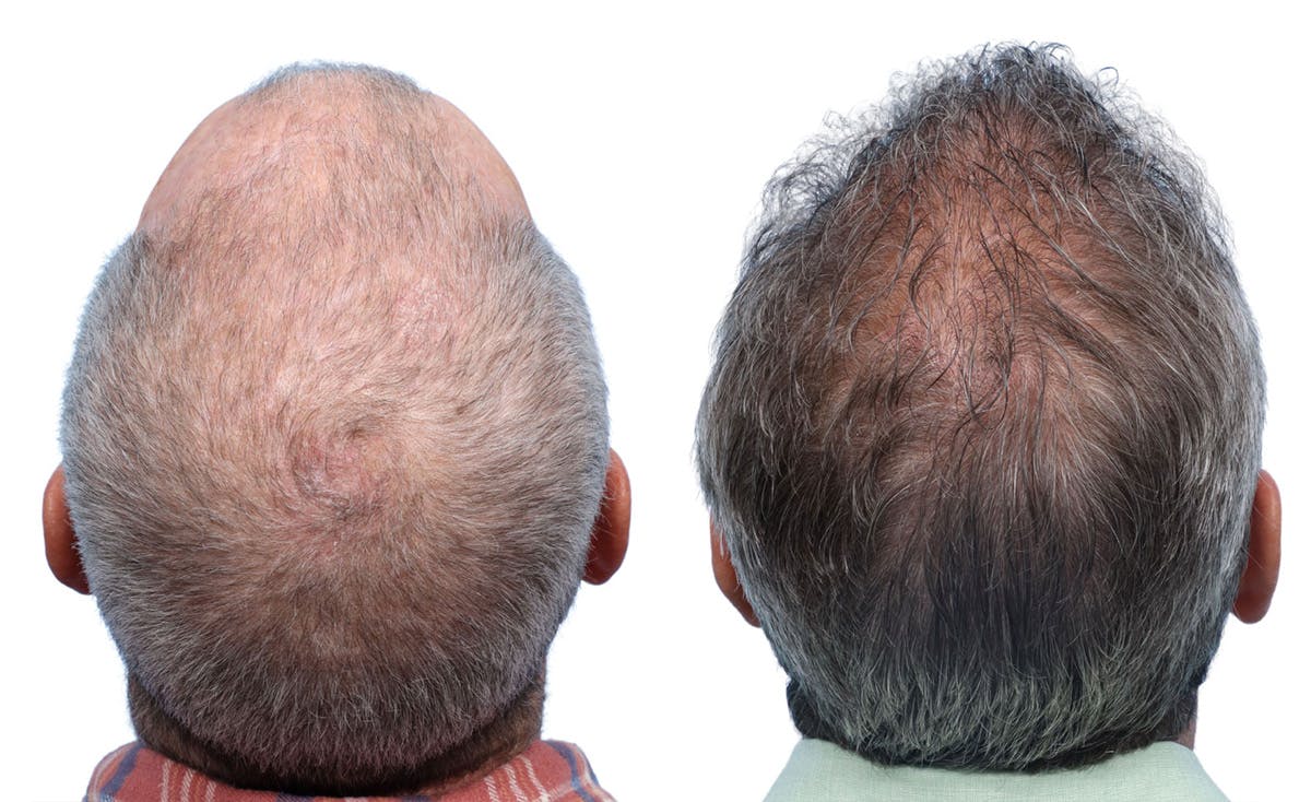 FUE Hair Transplant Before & After Gallery - Patient 242809 - Image 5