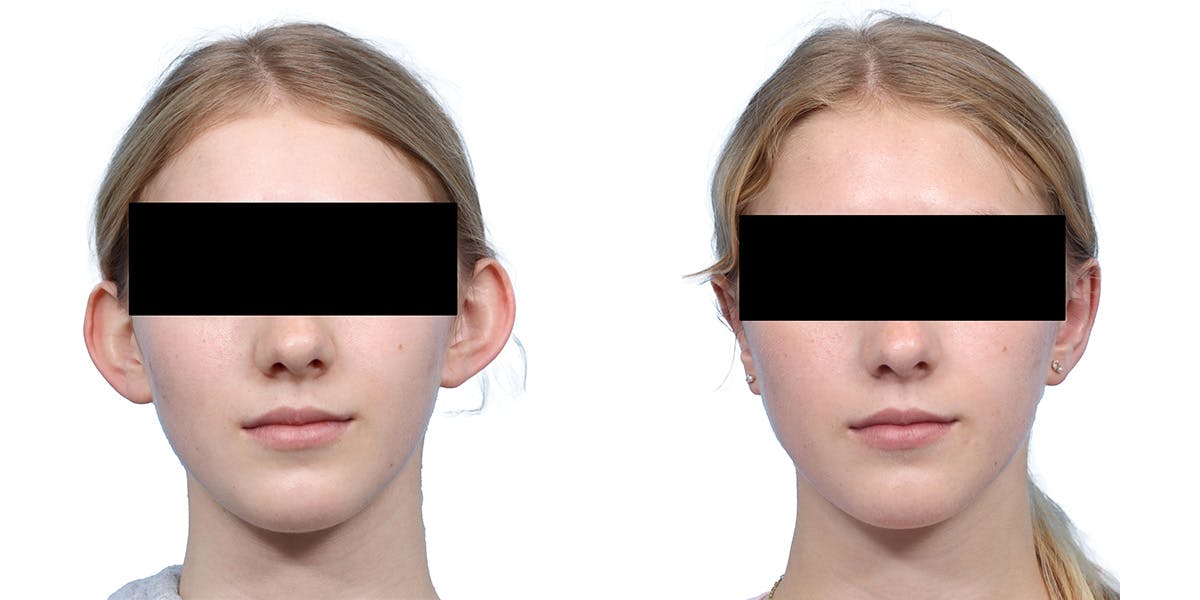 Otoplasty (Ear Surgery) Before & After Gallery - Patient 160305 - Image 1
