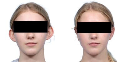 Otoplasty (Ear Surgery) Before & After Gallery - Patient 160305 - Image 1