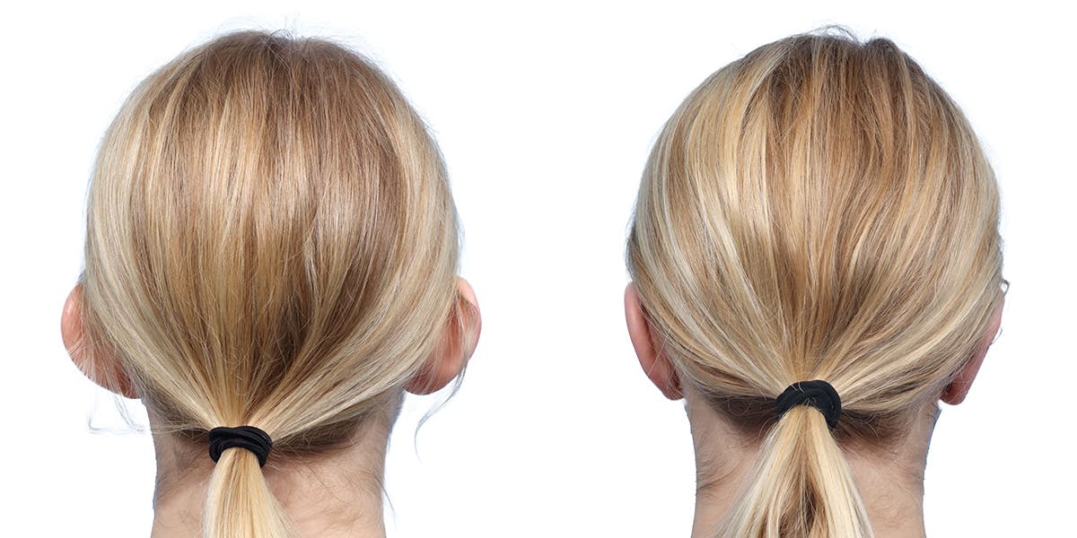 Otoplasty (Ear Surgery) Before & After Gallery - Patient 160305 - Image 2