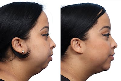 Chin Augmentation Before & After Gallery - Patient 359908 - Image 1