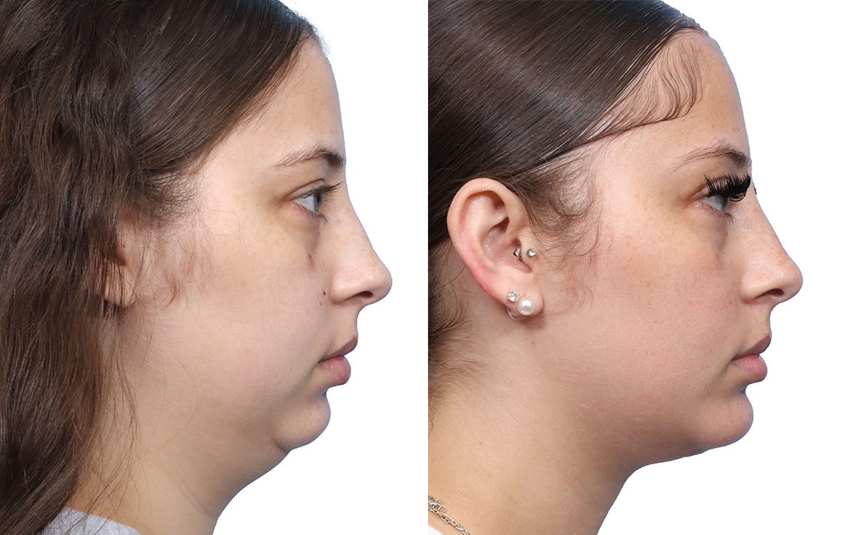 Chin Augmentation Before & After Gallery - Patient 130475 - Image 1