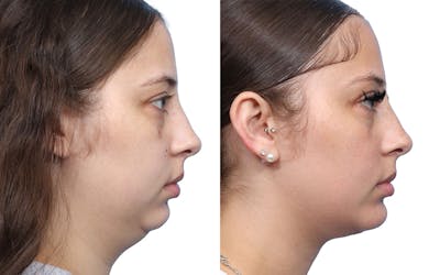 Chin Augmentation Before & After Gallery - Patient 130475 - Image 1