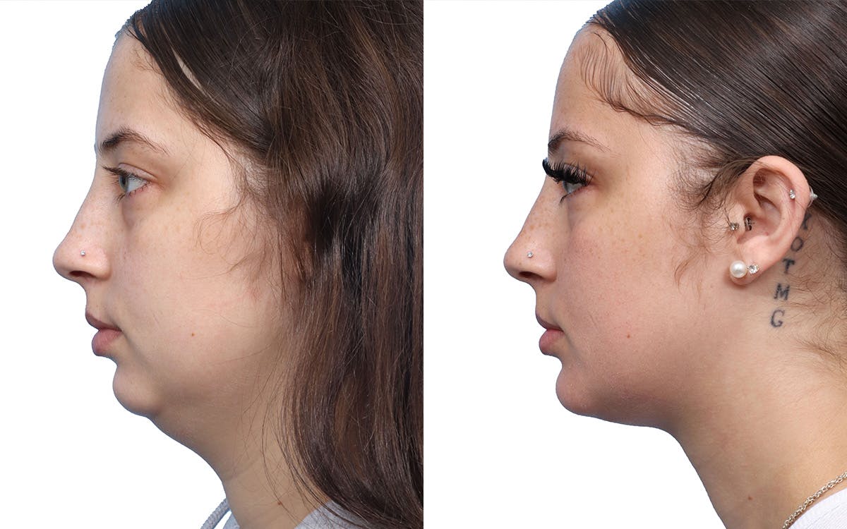 Chin Augmentation Before & After Gallery - Patient 130475 - Image 2