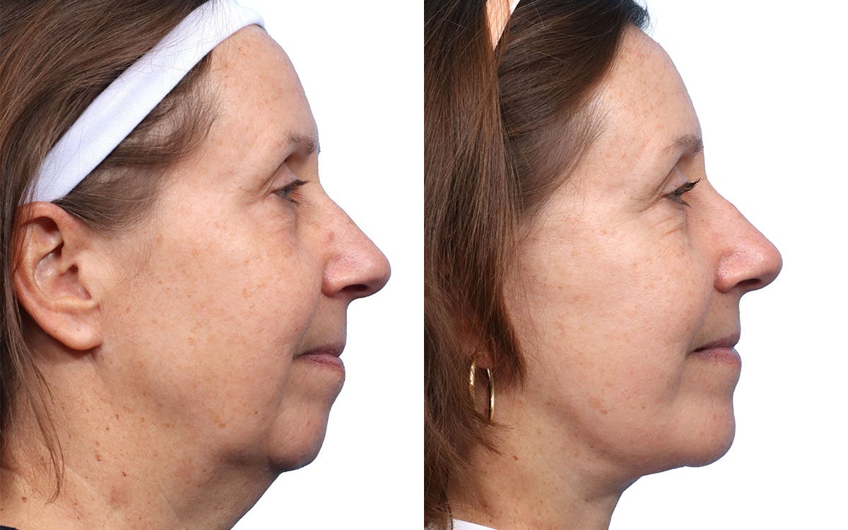 Deep Plane Facelift Before & After Gallery - Patient 197523 - Image 1