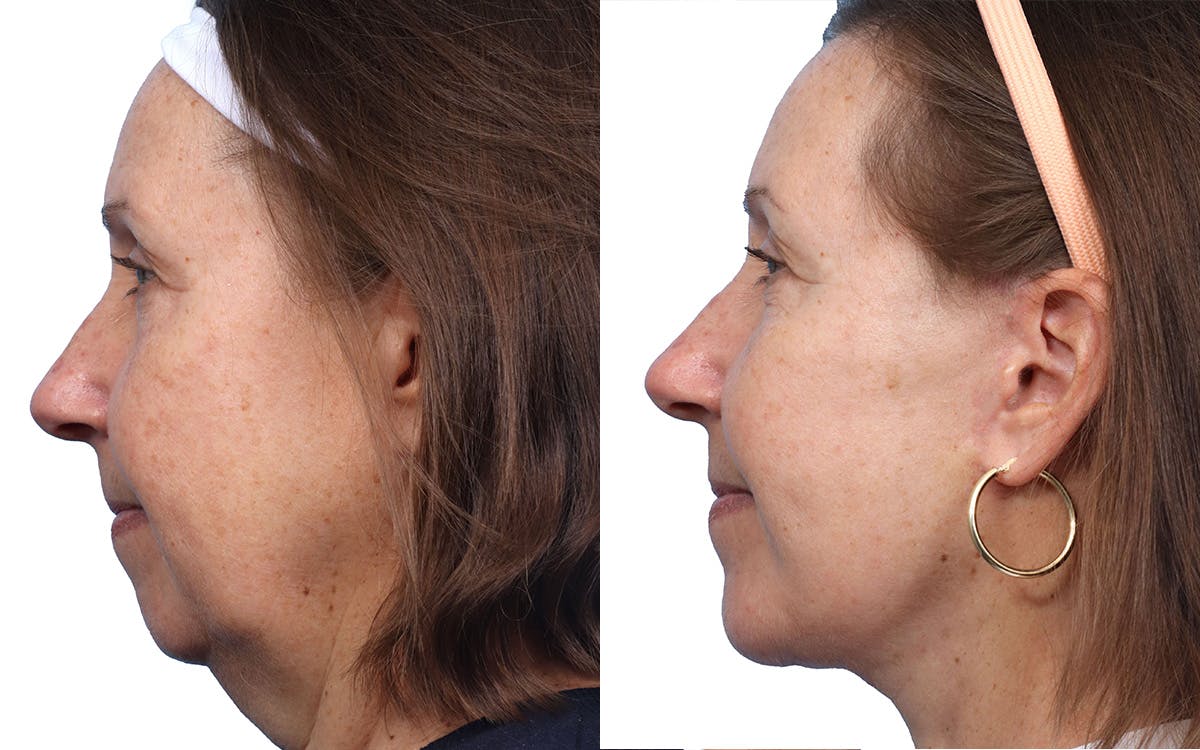 Deep Plane Facelift Before & After Gallery - Patient 197523 - Image 2