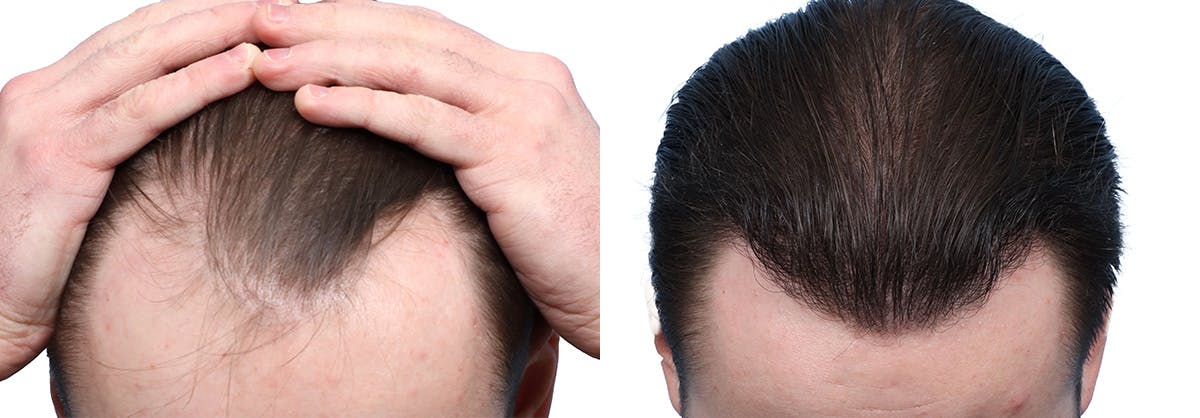 FUE Hair Transplant Before & After Gallery - Patient 594152 - Image 1