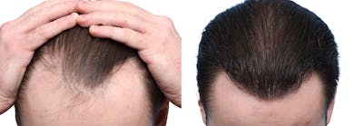 FUE Hair Transplant Before & After Gallery - Patient 594152 - Image 1
