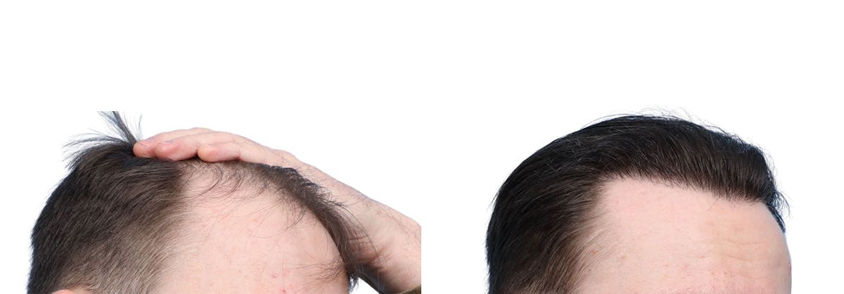 FUE Hair Transplant Before & After Gallery - Patient 594152 - Image 2