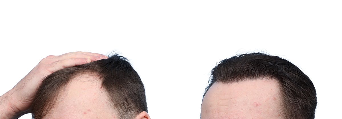 FUE Hair Transplant Before & After Gallery - Patient 594152 - Image 3