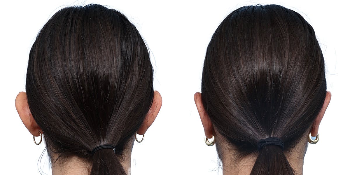 Otoplasty (Ear Surgery) Before & After Gallery - Patient 412740 - Image 2
