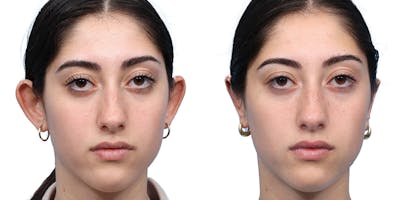 Otoplasty (Ear Surgery) Before & After Gallery - Patient 412740 - Image 1