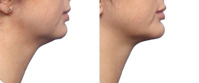 Chin Augmentation Before & After Gallery - Patient 435195 - Image 1