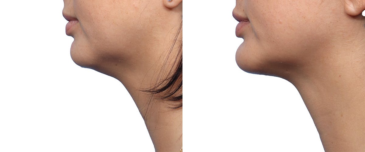 Chin Augmentation Before & After Gallery - Patient 435195 - Image 2