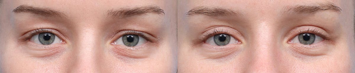 Blepharoplasty (Eyelid Surgery) Before & After Gallery - Patient 250042 - Image 1