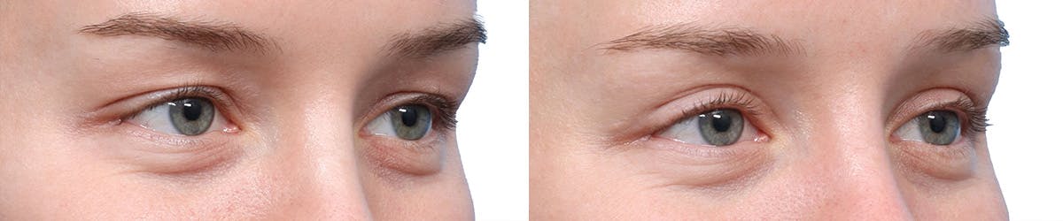 Blepharoplasty (Eyelid Surgery) Before & After Gallery - Patient 250042 - Image 2