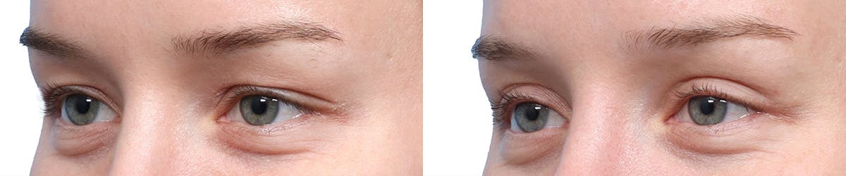 Blepharoplasty (Eyelid Surgery) Before & After Gallery - Patient 250042 - Image 3