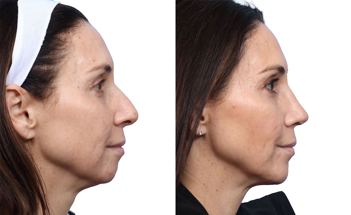 Chin Augmentation Before & After Gallery - Patient 264026 - Image 1