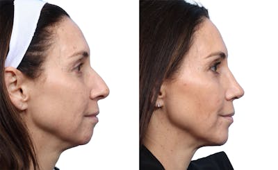 Chin Augmentation Before & After Gallery - Patient 264026 - Image 1