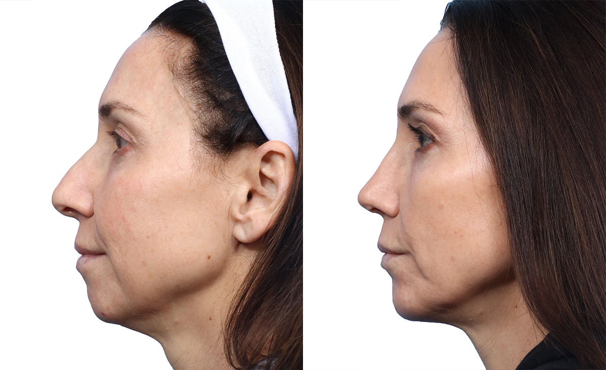 Chin Augmentation Before & After Gallery - Patient 264026 - Image 2