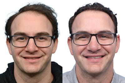 FUE Hair Transplant Before & After Gallery - Patient 104743 - Image 1