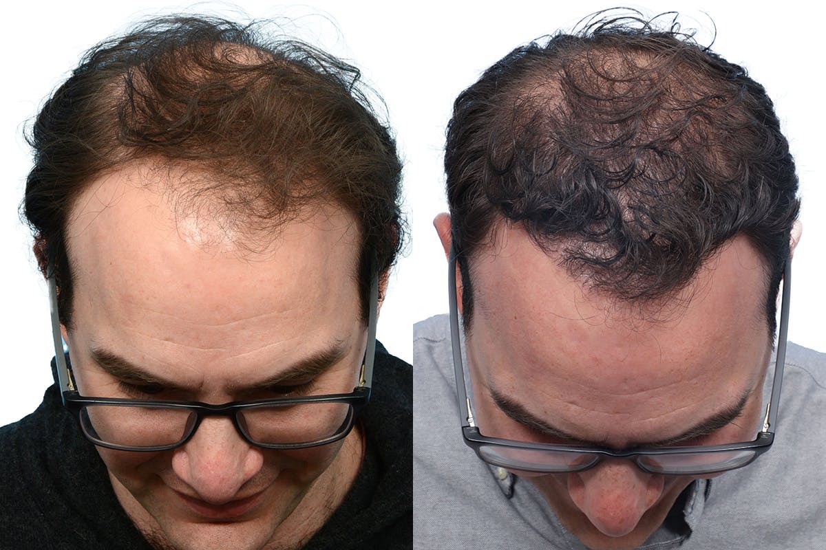 FUE Hair Transplant Before & After Gallery - Patient 104743 - Image 2