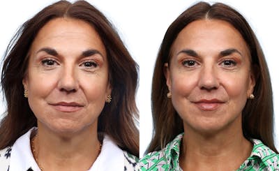 Liquid Facelift Before & After Gallery - Patient 427933 - Image 1