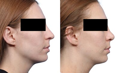 Rhinoplasty Before & After Gallery - Patient 246236 - Image 1