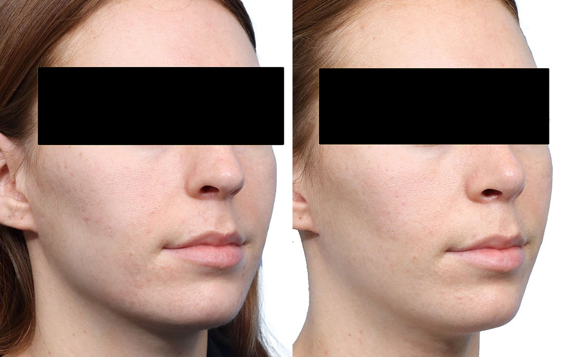 Rhinoplasty Before & After Gallery - Patient 246236 - Image 2