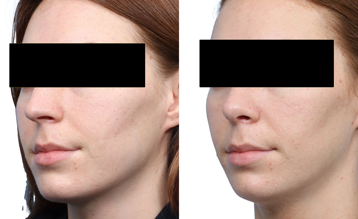 Rhinoplasty Before & After Gallery - Patient 246236 - Image 3