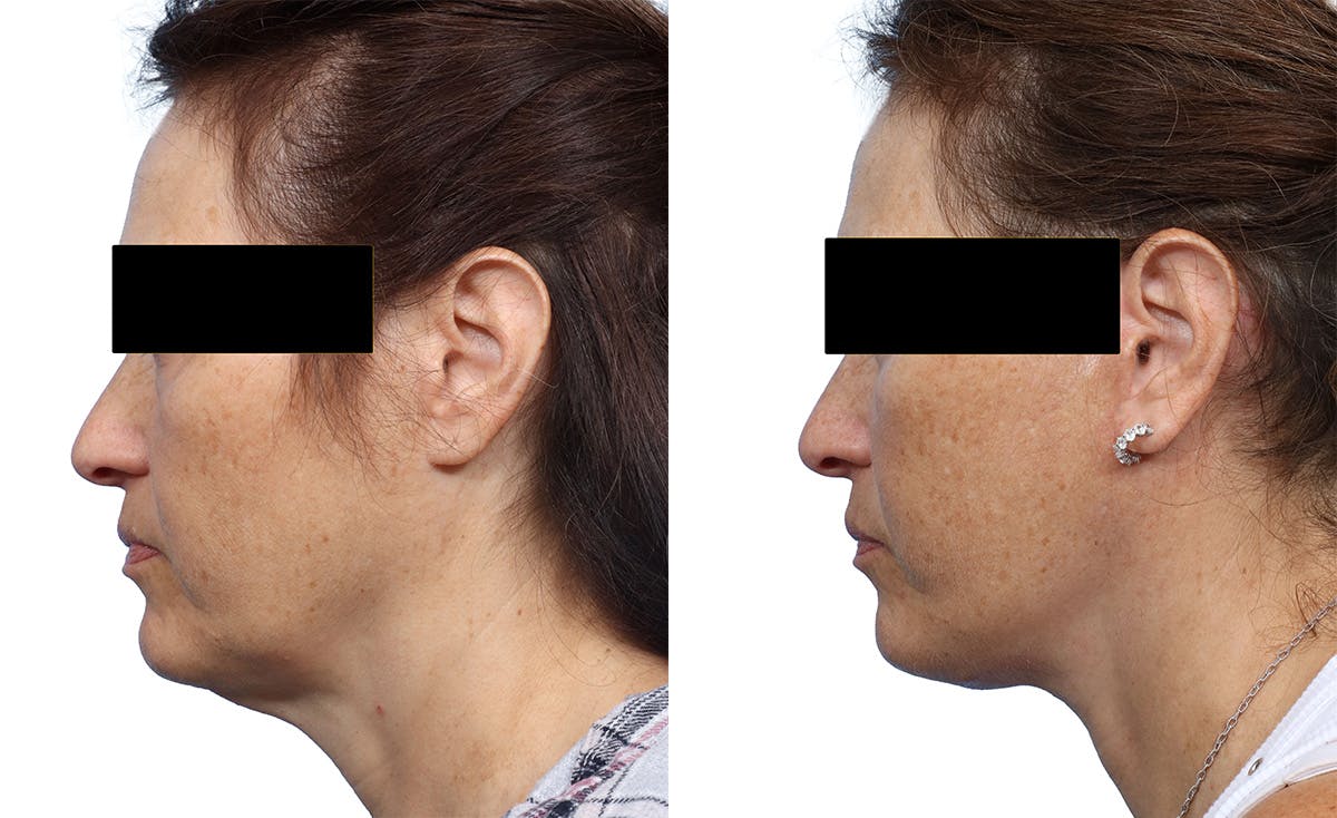 Facelift Before & After Gallery - Patient 402863 - Image 1