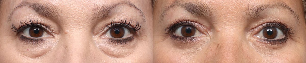 Blepharoplasty (Eyelid Surgery) Before & After Gallery - Patient 797582 - Image 1