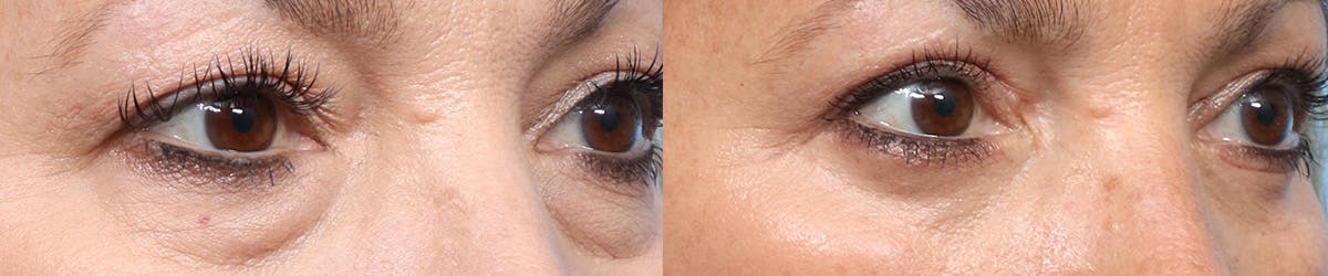 Blepharoplasty (Eyelid Surgery) Before & After Gallery - Patient 797582 - Image 2