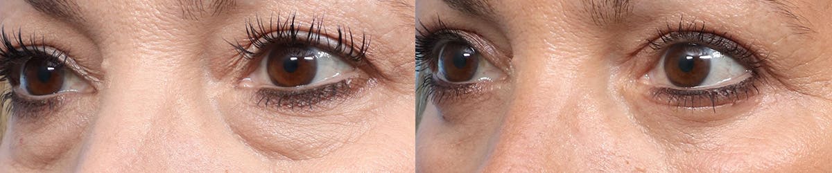 Blepharoplasty (Eyelid Surgery) Before & After Gallery - Patient 797582 - Image 3