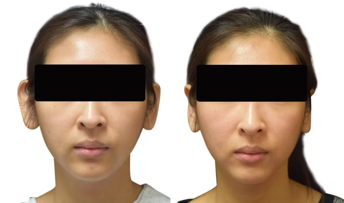 Otoplasty (Ear Surgery) Before & After Gallery - Patient 335889 - Image 1