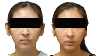 Otoplasty (Ear Surgery) Before & After Gallery - Patient 335889 - Image 1