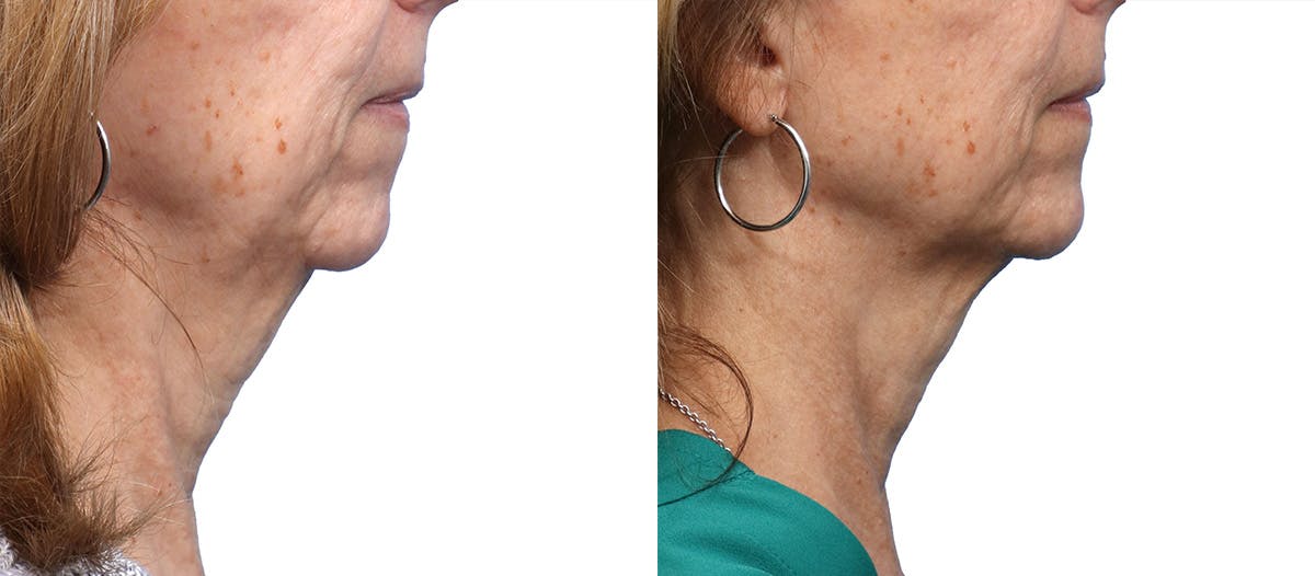 Morpheus8® Before & After Gallery - Patient 151304 - Image 1